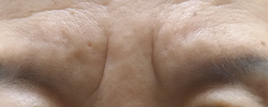 미간 주름 절제 전.JPG