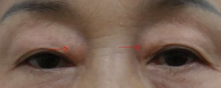 1속눈썹위 안쪽 피부절제 전.JPG