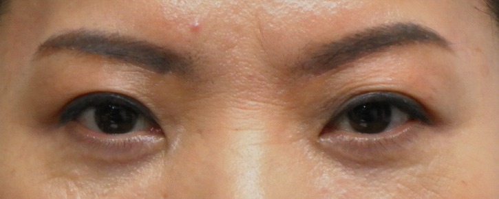 눈썹밑 피부절제 후.JPG