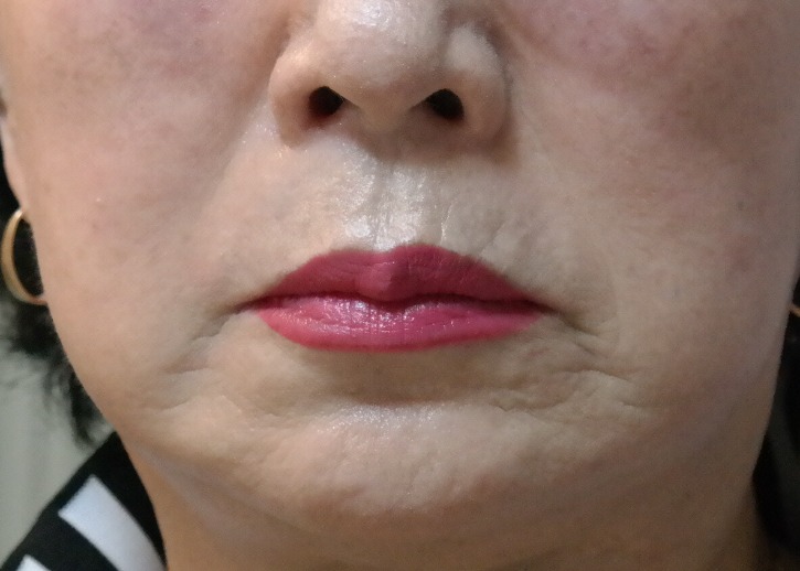 얼굴땡김 후.JPG