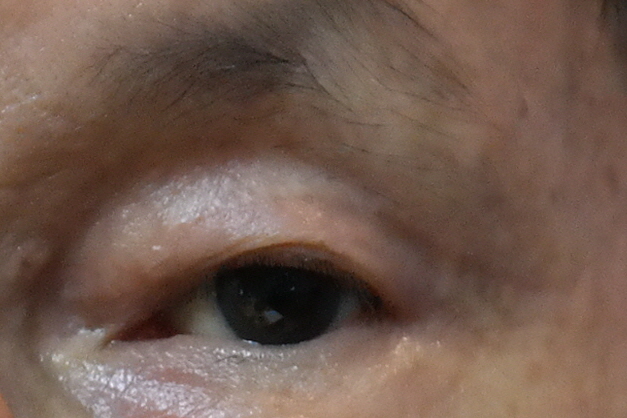 속 눈썹의 피부절제 후.JPG