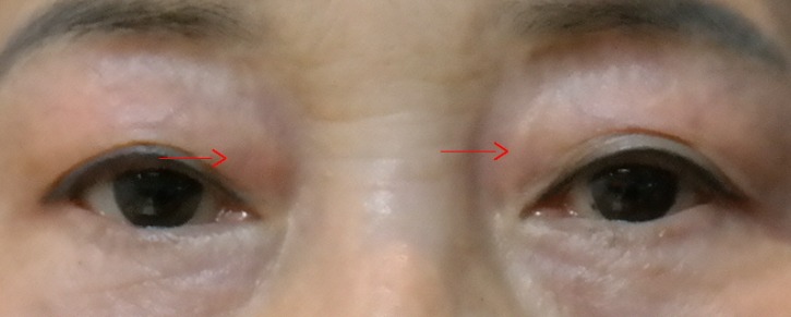 2속 눈썹위 안쪽 피부절제 후.JPG
