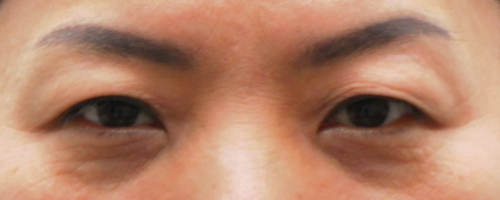 눈썹밑 피부절제 전.JPG