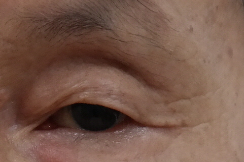 속 눈썹위 피부절제 전.JPG