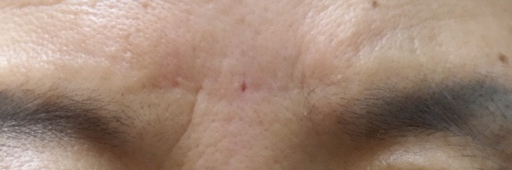 미간 주름 절제 후.JPG